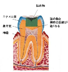 虫歯に詰め物をした直後