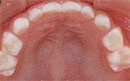 乳歯上顎