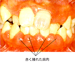赤く腫れた歯肉