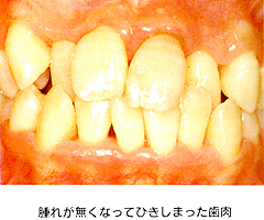 腫れが無くなって引きしまった歯肉