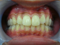 歯肉メラニン色素沈着(歯ぐきの黒ずみ)