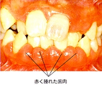 赤く腫れた歯肉