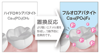 ハイドロキシアパタイトからフルオロアパタイトへ