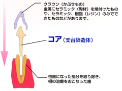 コア（支台築造体）仕組み