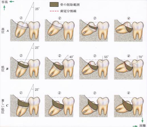 埋伏の深さと傾斜度から分類した抜歯の難易度