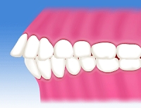 上顎前突(出っ歯)