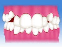 叢生(そうせい)